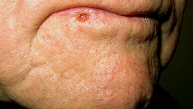 10 Things you didnt know about Squamous Cell Carcinoma