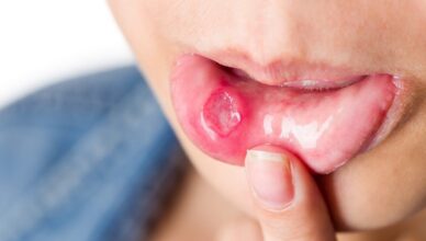 Best Home Remedies for Mouth Ulcers