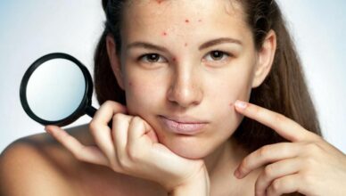 Five Best Natural ways to Reduce Pimples