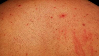 Get Rid of Back Acne with Natural Remedies