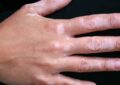 Get Some Relief from Skin Problem Vitiligo