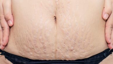 Get rid of Stretch Marks