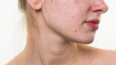 Home Remedies to get rid of Acne