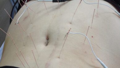 How can you Make use of Acupuncture for Weight Loss