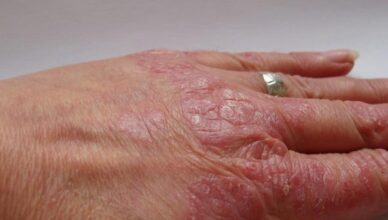 How can you Treat Psoriasis at Home