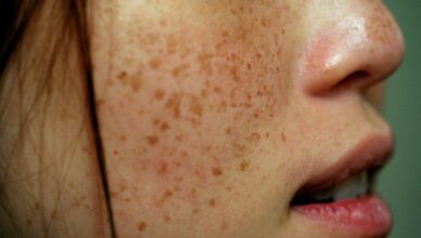 How to Treat Skin Pigmentation with Fruits and Veggies