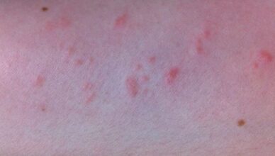 Natural Remedies for Red Bumps on Arms 700x336 1