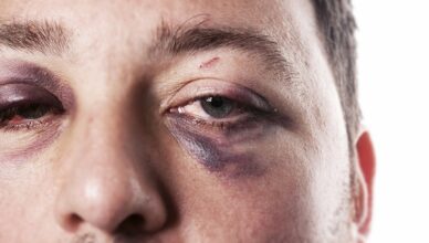 Top 5 Remedies for Black Eyes that can help you