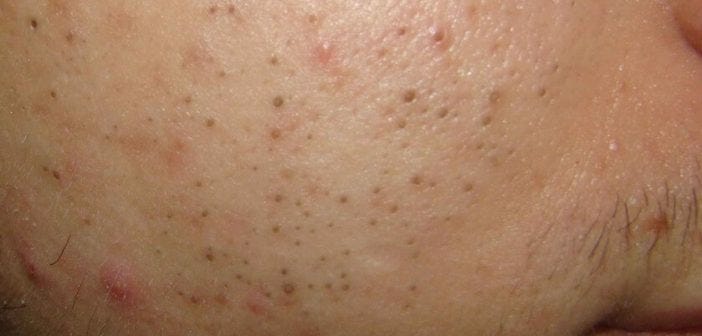 Effective Remedies for Blackheads