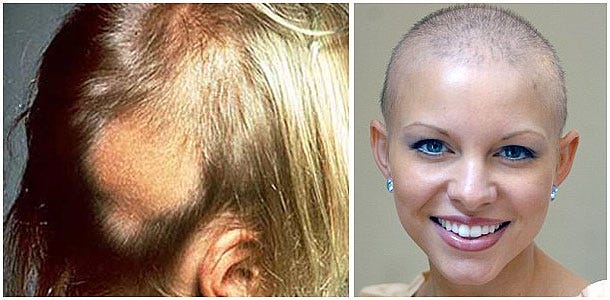 Connection between Hair Loss and Cancer