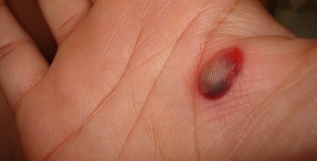 Best Remedies for Blood Blisters