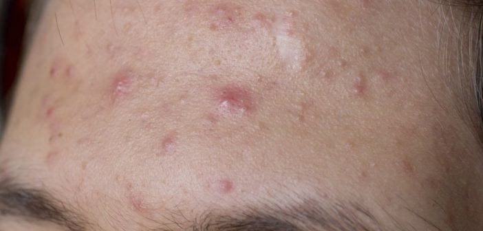 Do Dandruff and Pimples go Hand in Hand ?