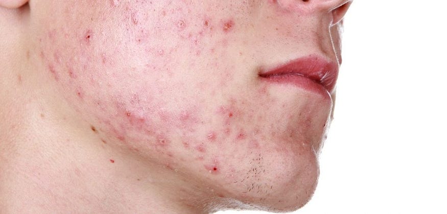 home made face wash for acne prone skin