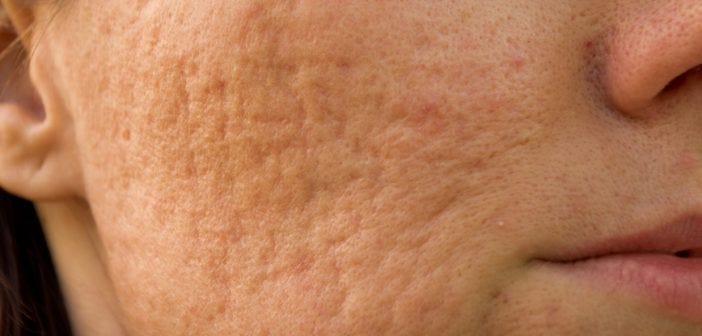 Best 5 Natural Remedies for Clogged Pores