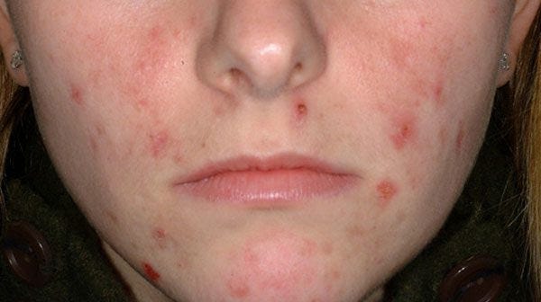 remedies for face acne