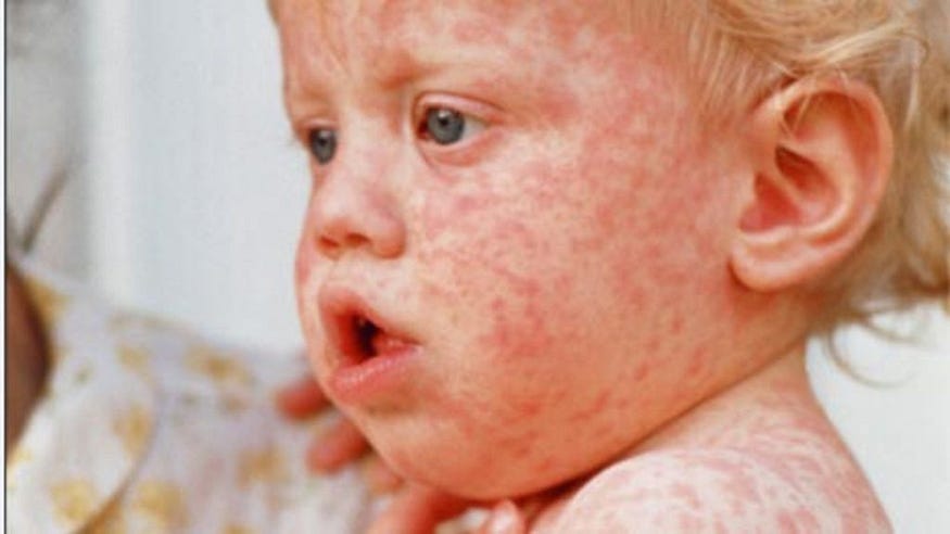 remedies for measles