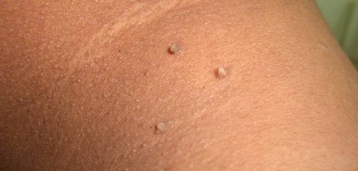 Home Remedies for Skin Tags