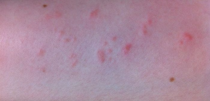 Natural Remedies for Red Bumps on Arms