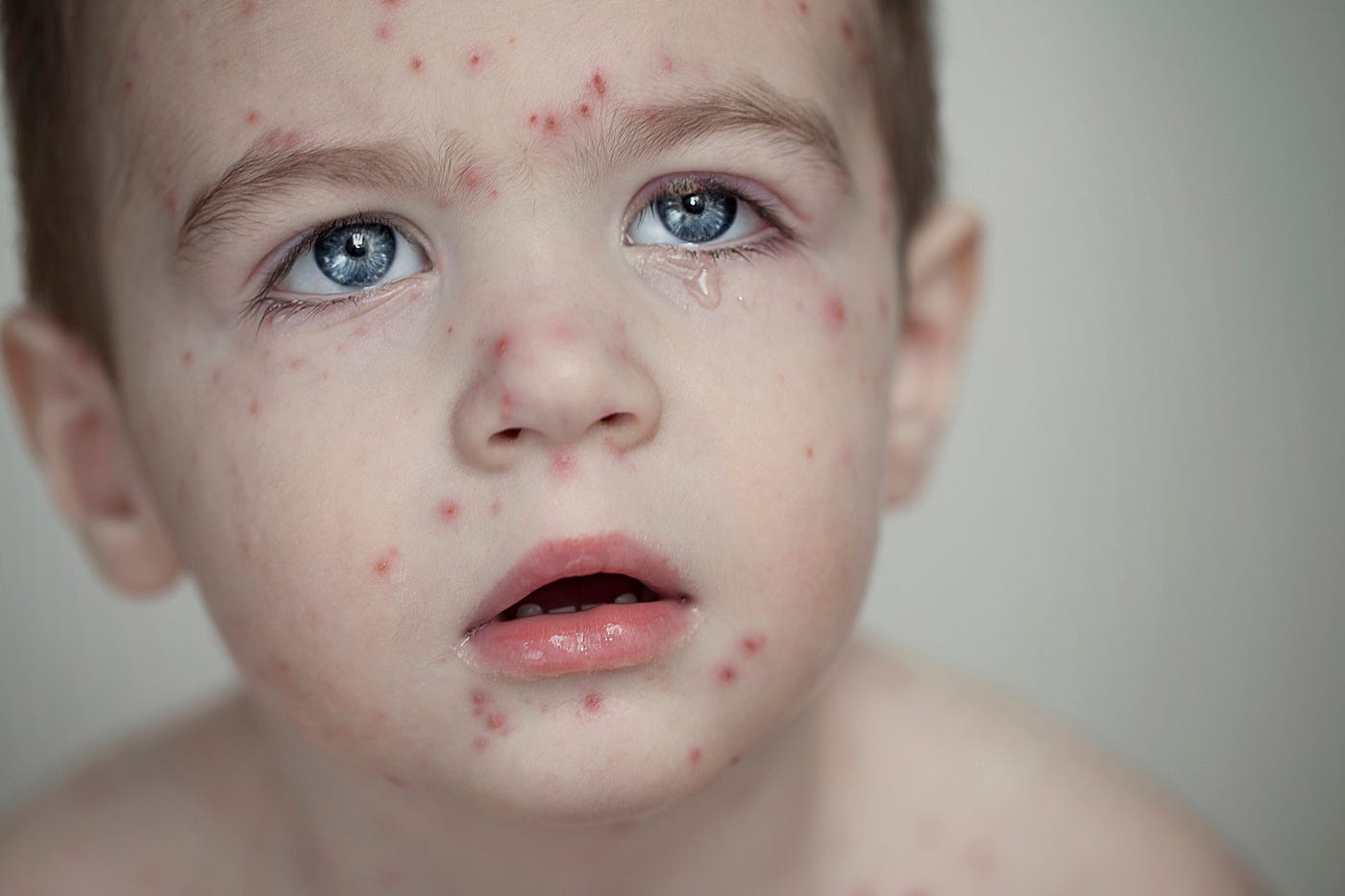 Remedies to get rid of Chickenpox Scars
