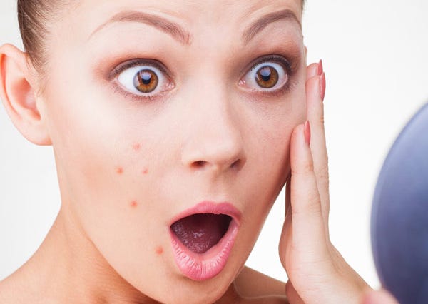 Remedies to Get Rid of Pimples