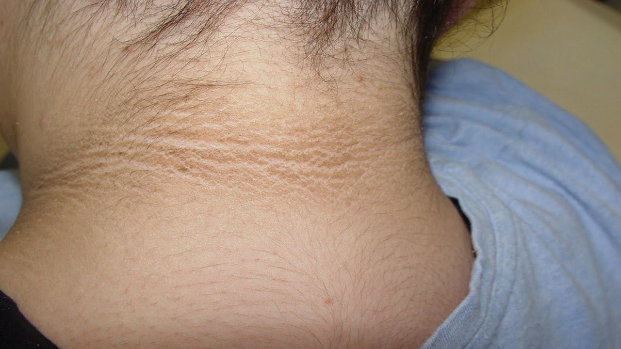 Remedies for Dark Skin on Neck