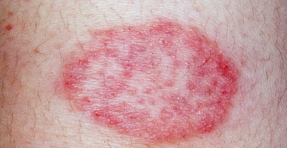 tips for skin infection