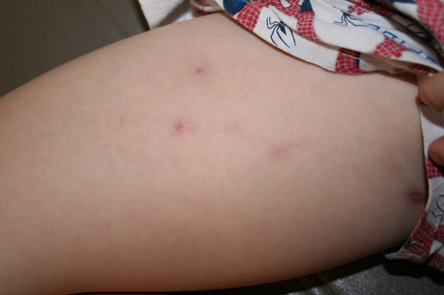 remedies for boils on inner thighs