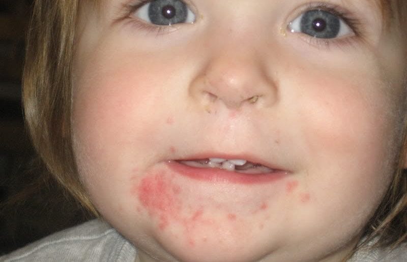 home remedies for candida