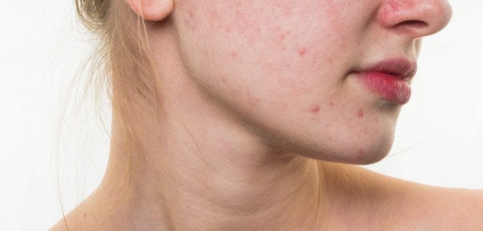 5 Useful Lifestyle Changes to Fight Acne