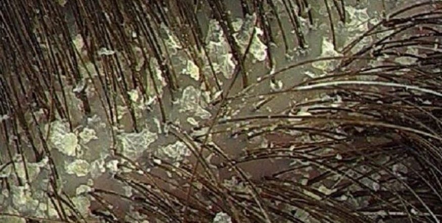 dandruff diet to get rid of dandruff