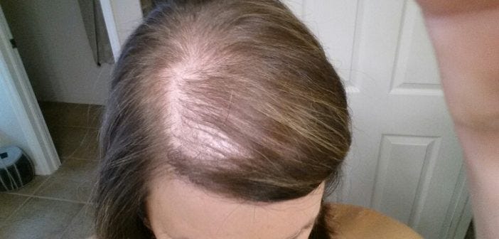 tips to stop hair thinning