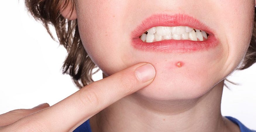 remedies for blind pimples