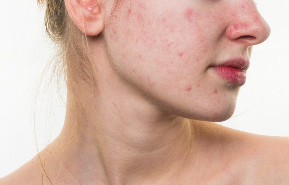 Quick Remedies to Get Rid of Pimples