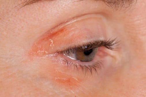 Eye Makeup Infections