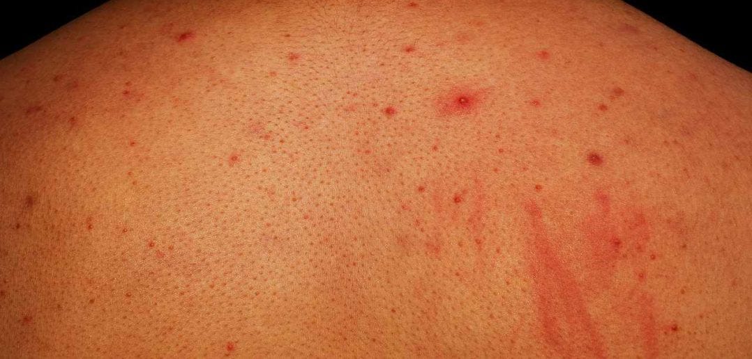 Get Rid of Back Acne with Natural Remedies