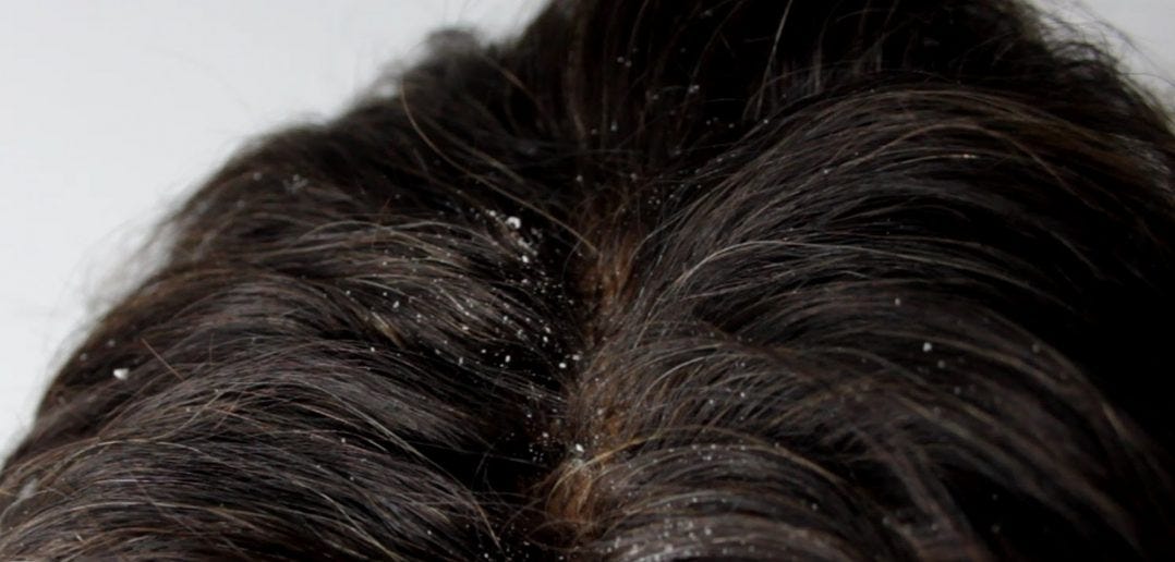 natural remedies for dandruff