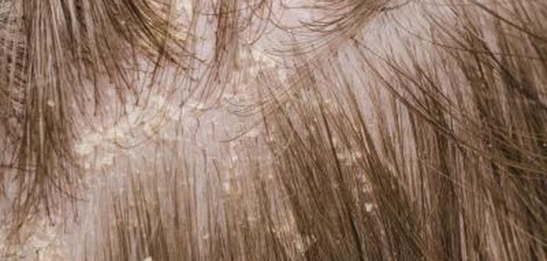 Best Home Made Remedies for Dandruff