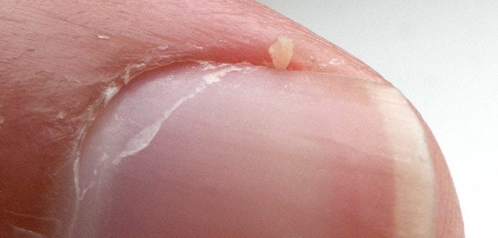 Best Remedies for Hangnails