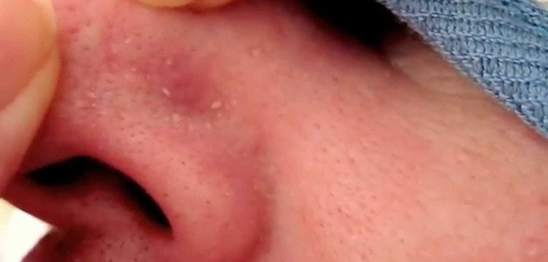 Effective White Heads Remedies