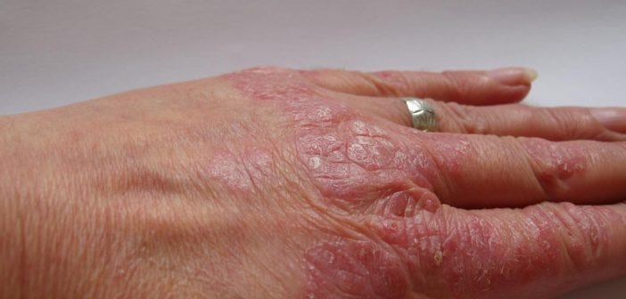 home remedies psoriasis