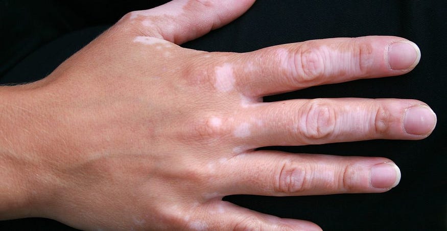 remedies for vitiligo