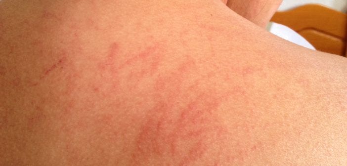remedies for skin allergy