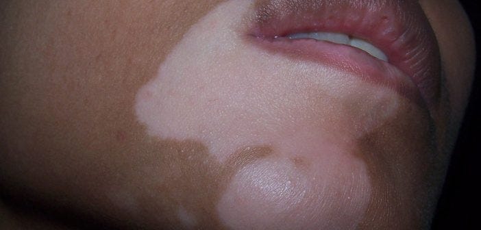 get rid of vitiligo